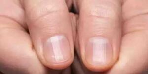 40 yaş sonrası tırnakta görülen bu çizgiler neyin habercisi?